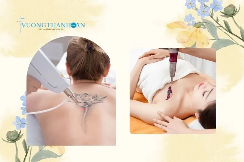 Địa chỉ xoá xăm Trà Vinh: Top 6 địa điểm uy tín, an toàn